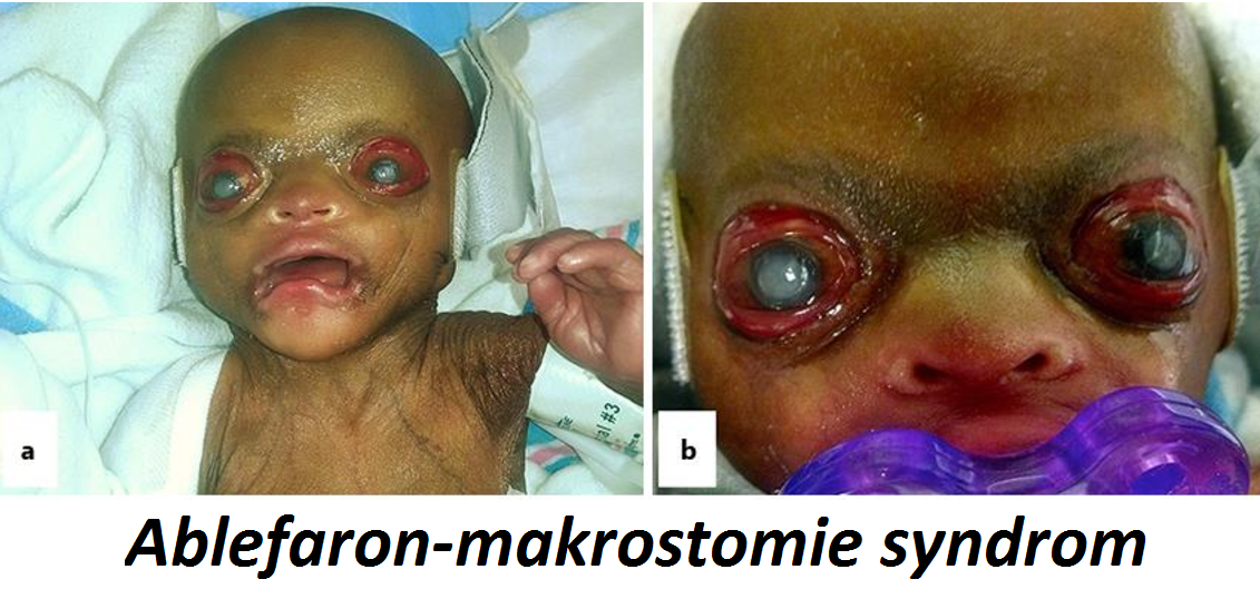 Ablefaron-makrostomie syndrom příznaky projevy symptomy příčina léčba fotografie obrázek
