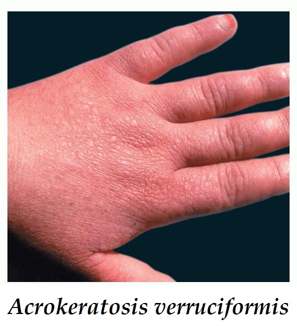 acrokeratosis-verruciformis-priznaky-projevy-symptomy
