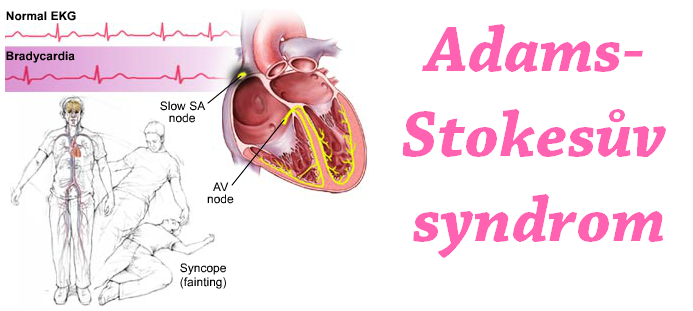 Adam-Stokesův syndrom příznaky projevy příčina léčba