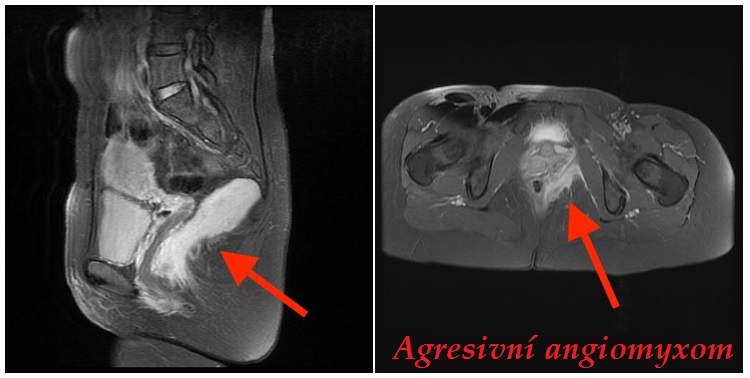 Agresivní angiomyxom příznaky projevy symptomy obrázek fotografie