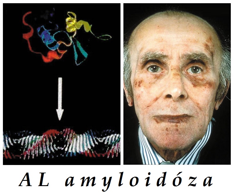 al amyloidoza primarni amyloidoza priznaky projevy symptomy