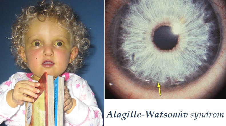 alagille watsonuv syndrom priznaky projevy symptomy pricina lecba fotografie obrazek