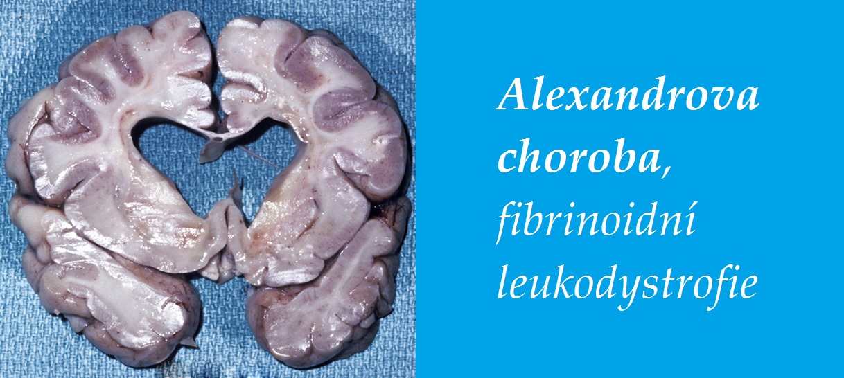 alexandrova choroba fibrinoidni leukodystrofie priznaky projevy symptomy 1