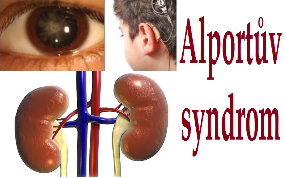 alportuv-syndrom-priznaky-projevy-symptomy