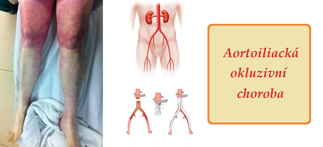 aortoiliacka okluzivni choroba priznaky projevy symptomy