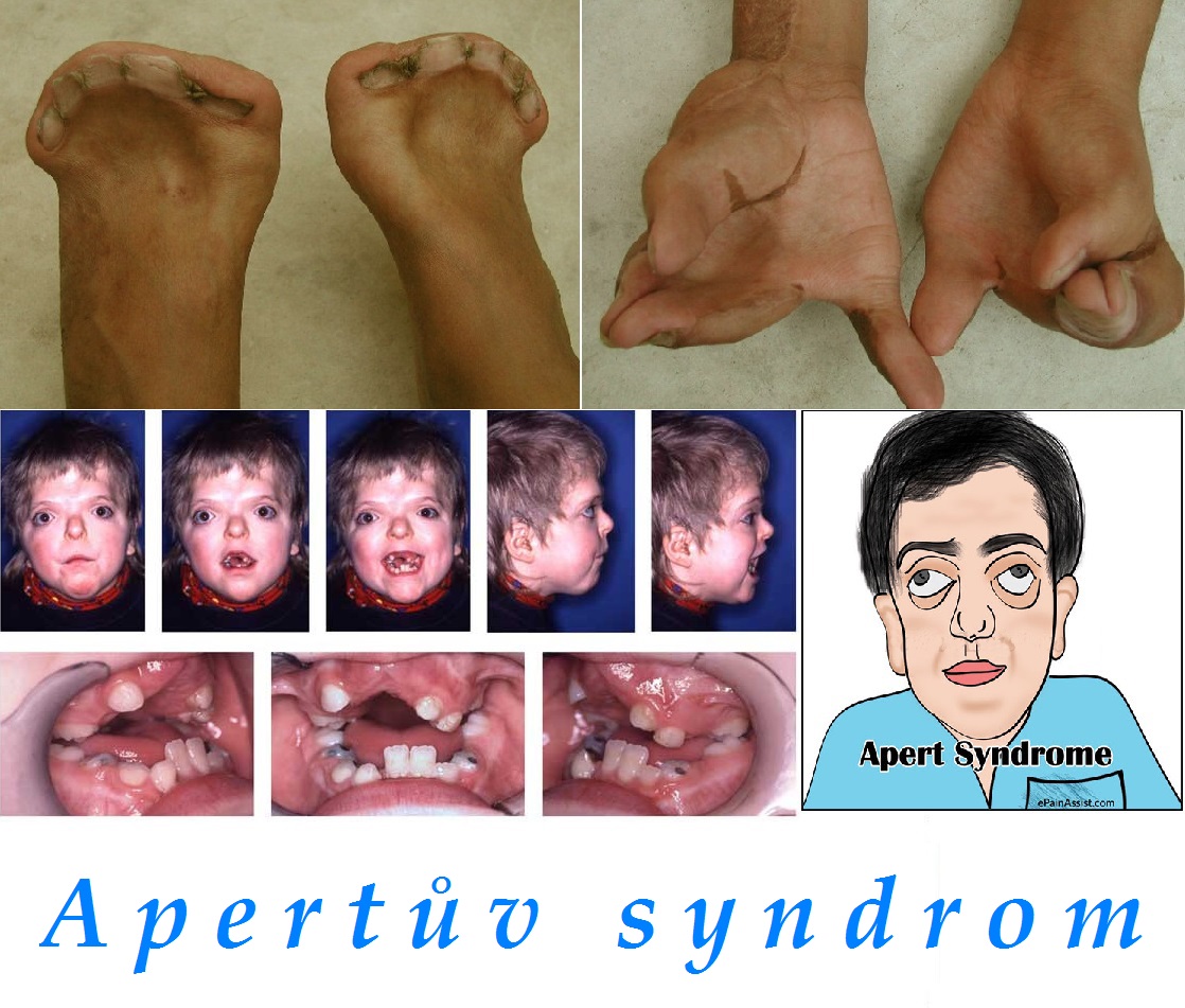 apertuv syndrom priznaky projevy symptomy