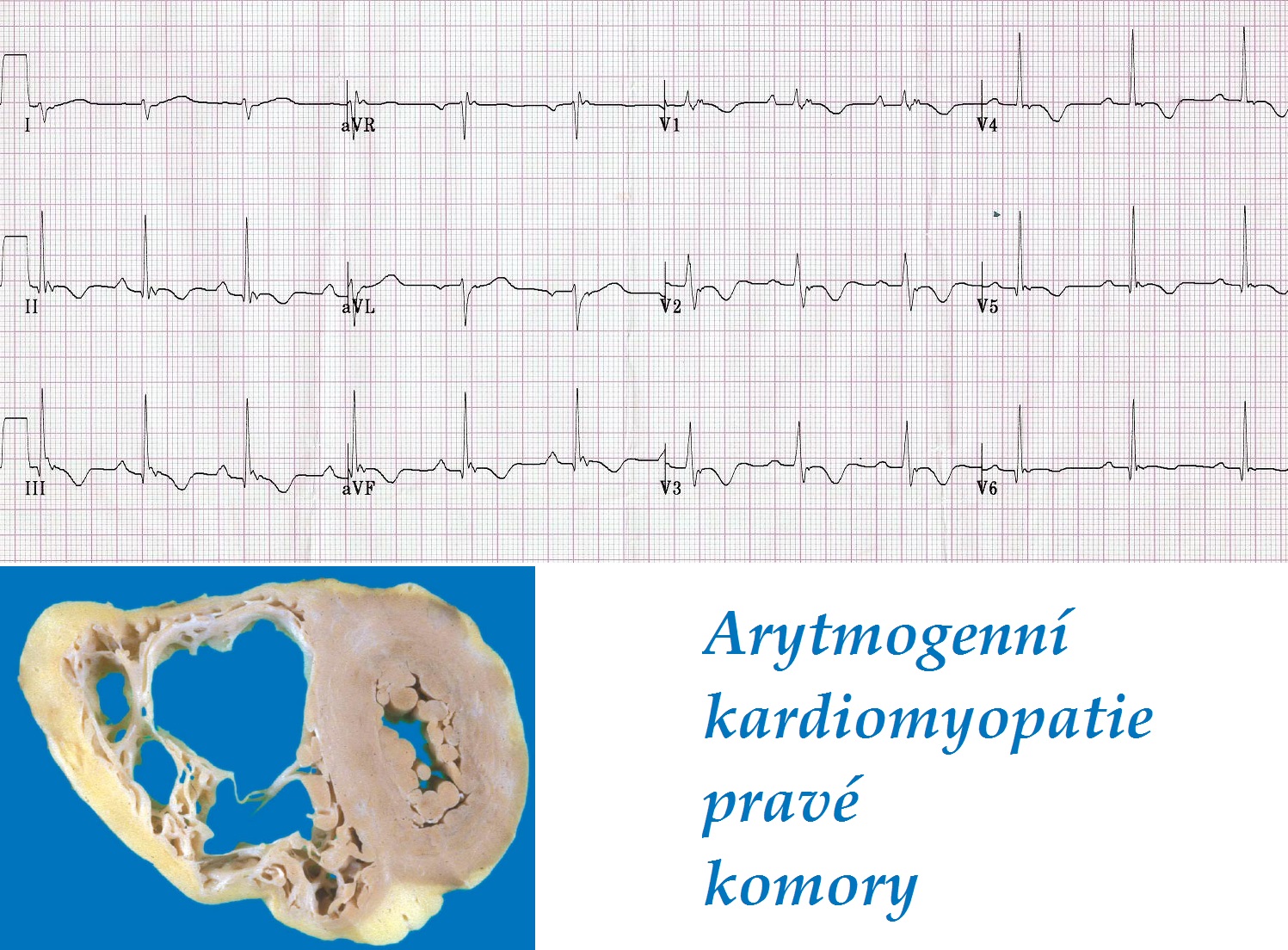 arytmogenni kardiomyopatie prave komory priznaky projevy symptomy EKG