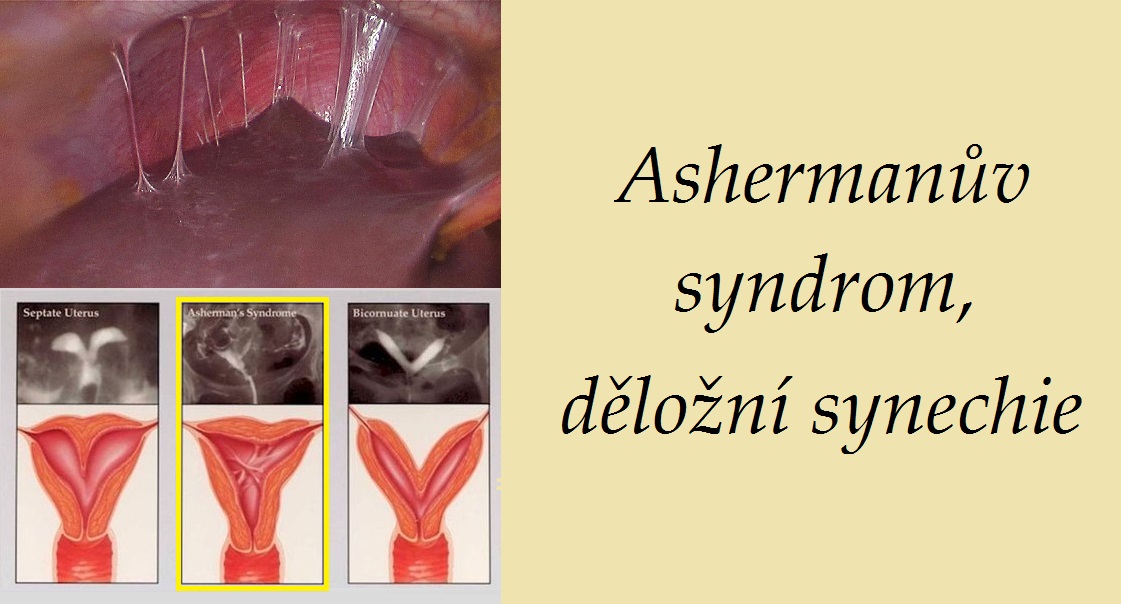 ashermanuv syndrom delozni synechie priznaky projevy symptomy