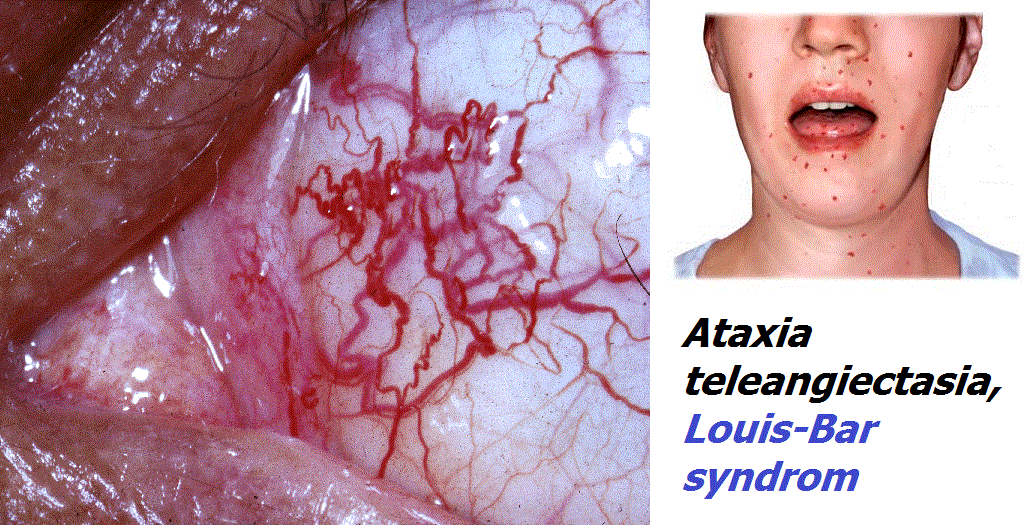 ataxia-telangiectasia-luis-bar-syndrom-priznaky-projevy-symptomy