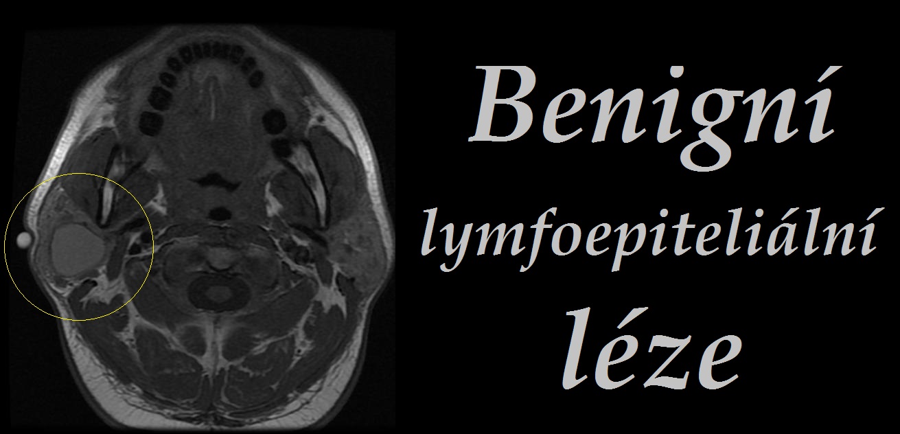benigni-lymfoepitelialni-leze-priznaky-projevy-symptomy