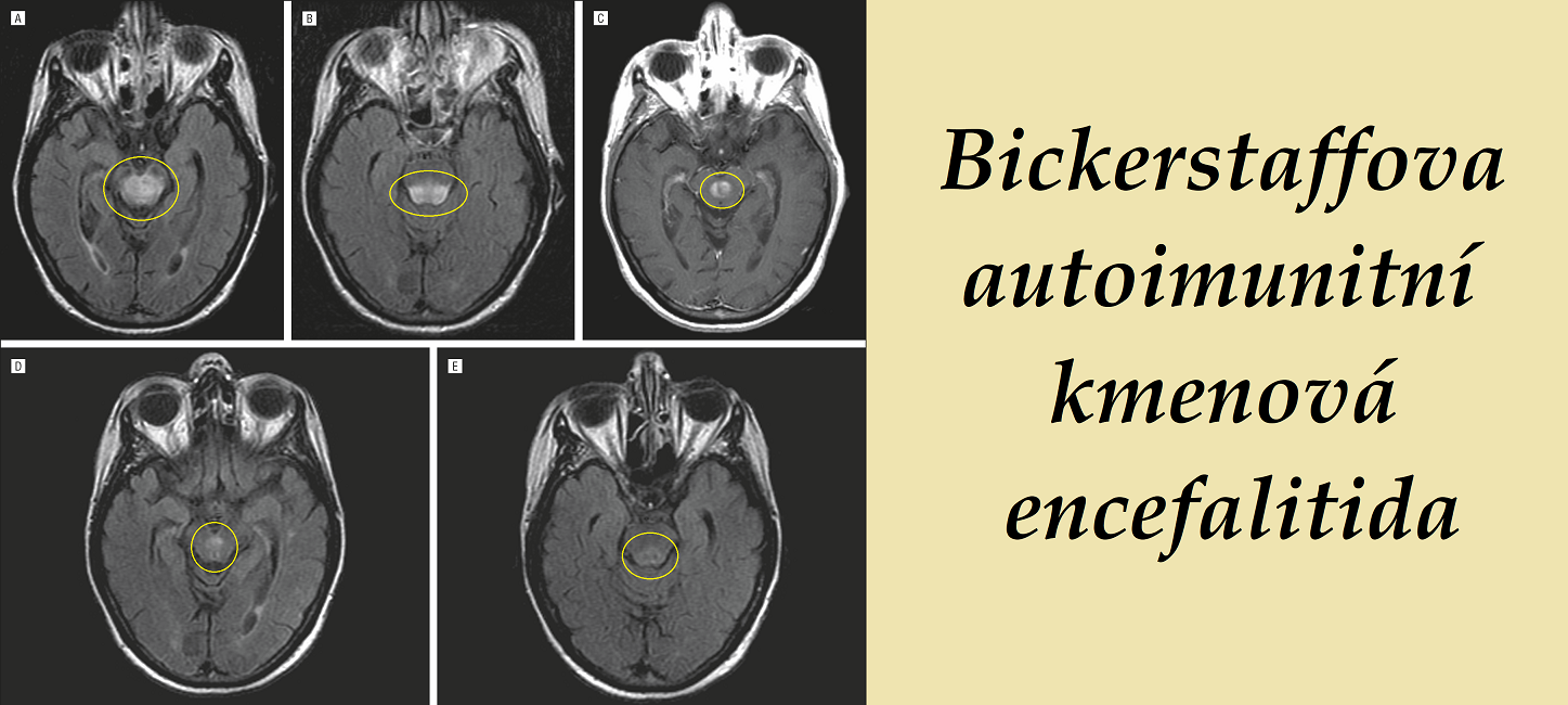 Bickerstaffova autoimunitní kmenová encefalitida příznaky projevy léčba příčina symptomy