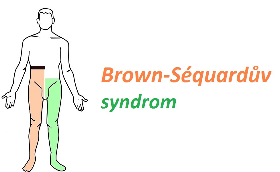 brown-sequarduv-syndrom-priznaky-projevy-symptomy-2