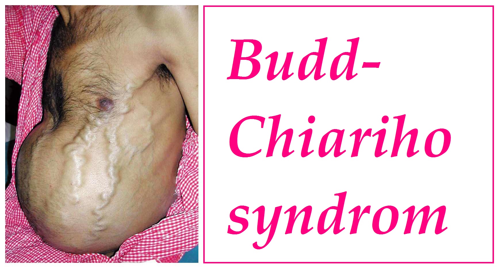 budd-chiariho-syndrom-priznaky-projevy-symptomy