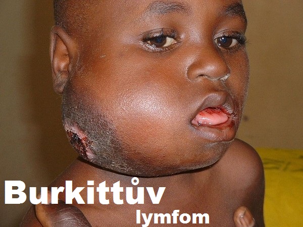 burkittuv-lymfom-priznaky-projevy-symptomy