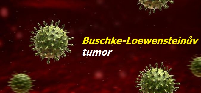 buschke-loewensteinuv-tumor-priznaky-projevy-symptomy-obrazek-fotografie