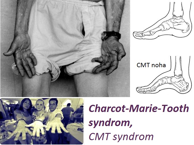 charcot-marie-tooth-syndrom-cmt-syndrom-priznaky-projevy-symptomy