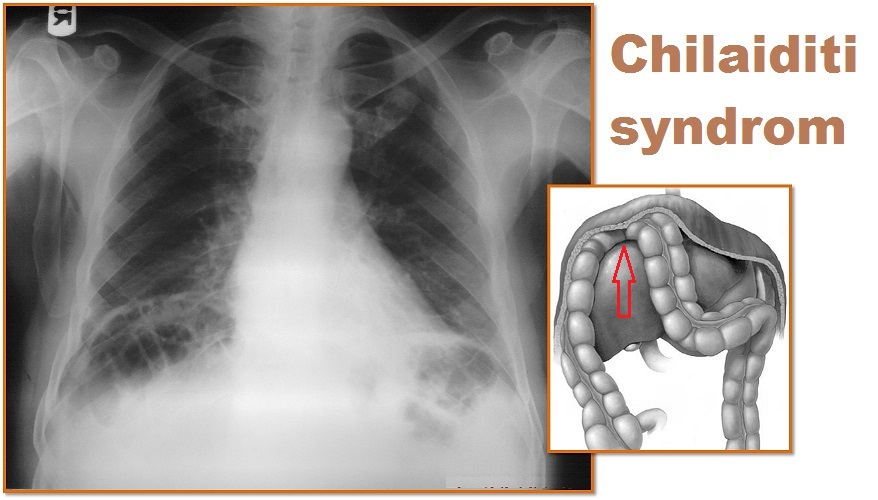 chilaiditiho-syndrom-priznaky-projevy-symptomy