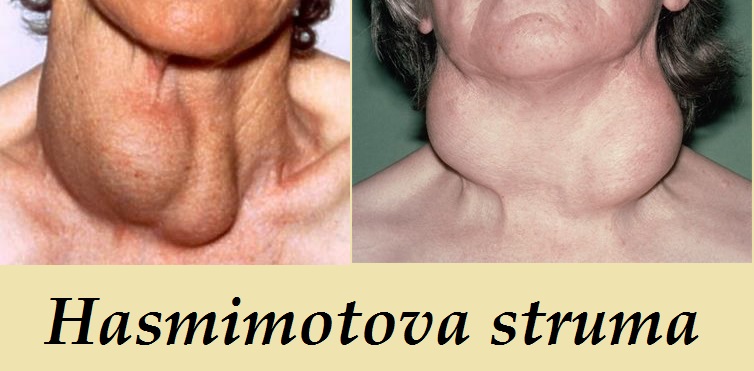 chronicky-zanet-stitne-zlazy-tyreoiditida-hashimotova-struma-priznaky-projevy-symptomy