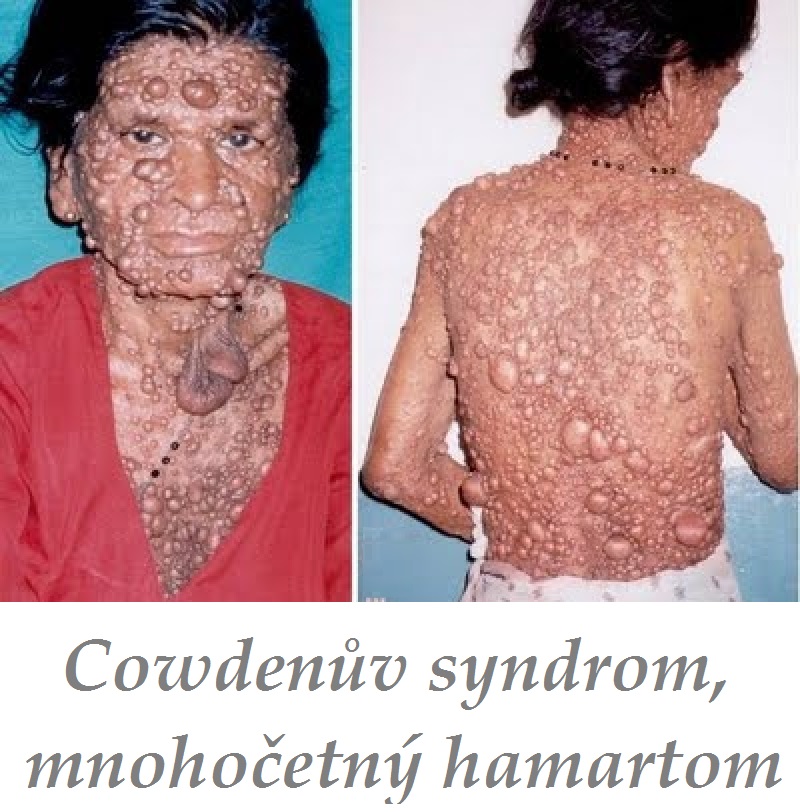 cowdenuv-syndrom-mnohocetny-hamartom-priznaky-projevy-symptomy copy