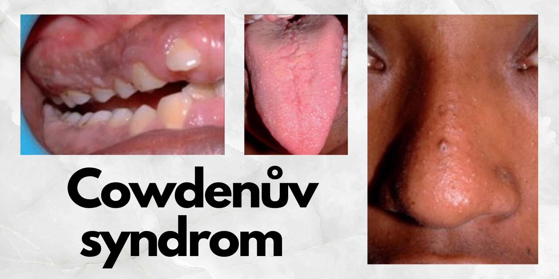 cowdenuv syndrom priznaky projevy symptomy fototografie diagnostika lecba