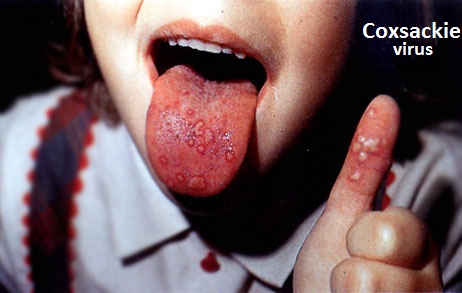 coxsackie-infekce-priznaky-projevy-symptomy