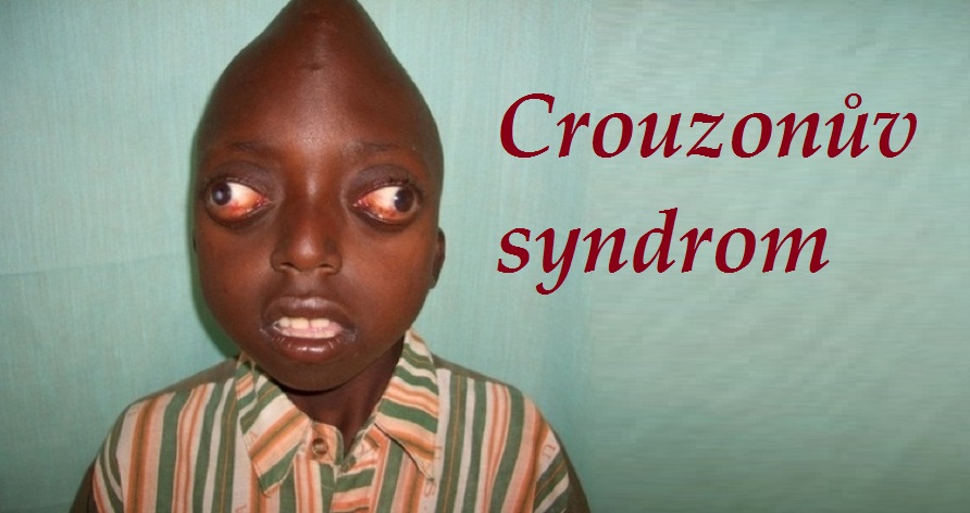crouzonuv-syndrom-priznaky-projevy-symptomy