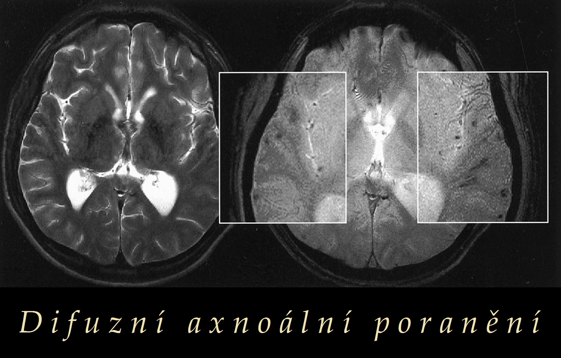 difuzni axonalni poraneni priznaky projevy symptomy obrazek fotografie