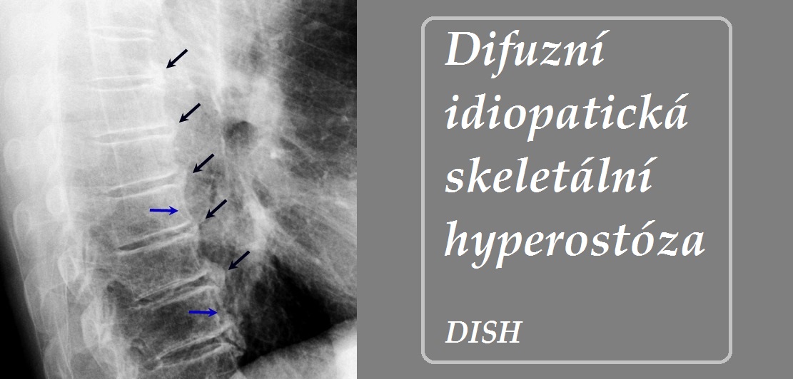 difuzni-idiopaticka-skeletalni-hyperostoza-priznaky-projevy-symptomy