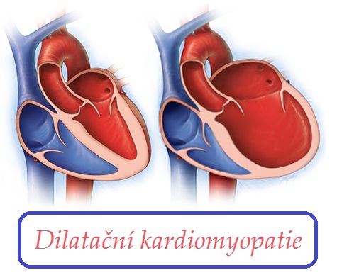 dilatacni kardiomyopatie priznaky projevy symptomy