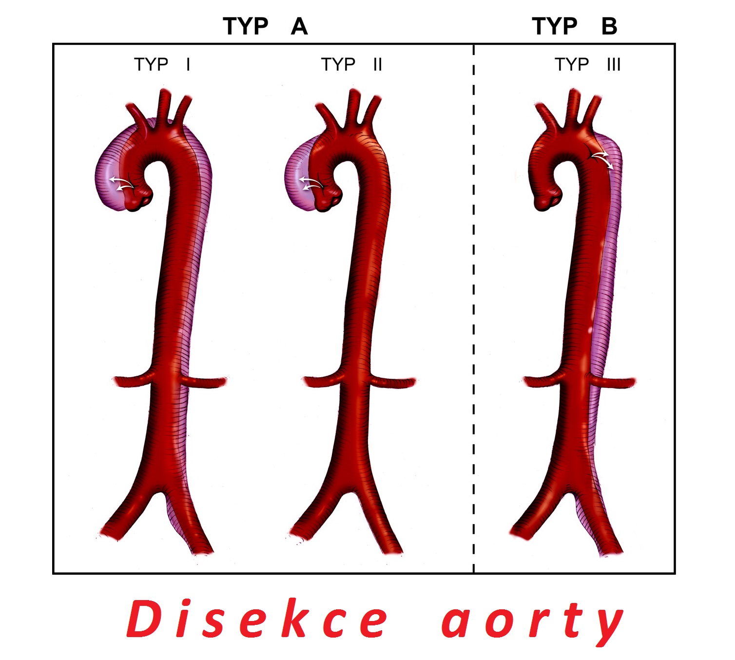 disekce aorty srdecnice priznaky projevy symptomy pricina lecba