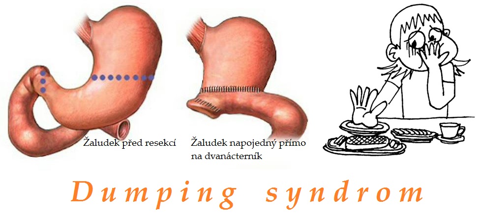 dumping syndrome syndrom odvodne klicky priznaky projevy symptomy