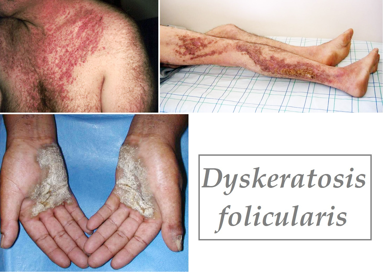 dyskeratosis-follicularis-priznaky-projevy-symptomy