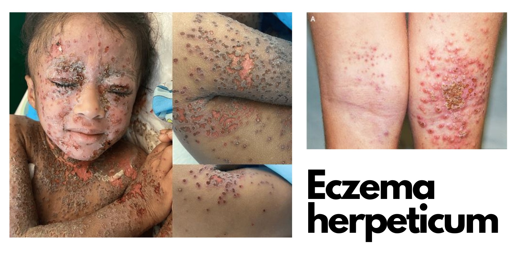 eczema herpeticum kaposiho variceliformni erupce priznaky projevy symptomy lecba diagnostika fotografie