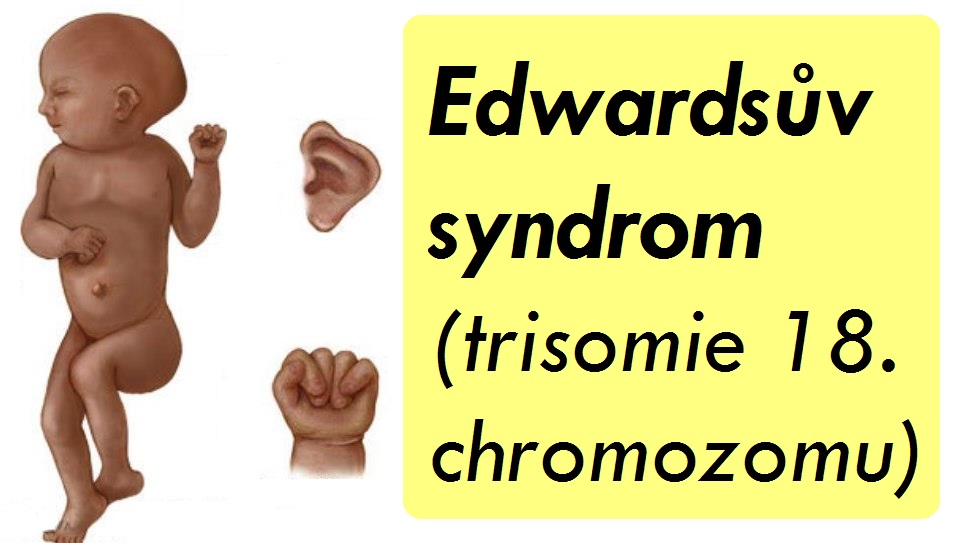 edwardsuv-syndrom-trisomie-18-priznaky-projevy-symptomy-33