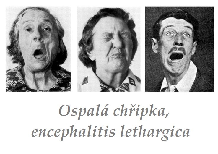 Ospalá chřipka - encephalitis lethargica - von economova encefalitida příznaky projevy příčina léčba