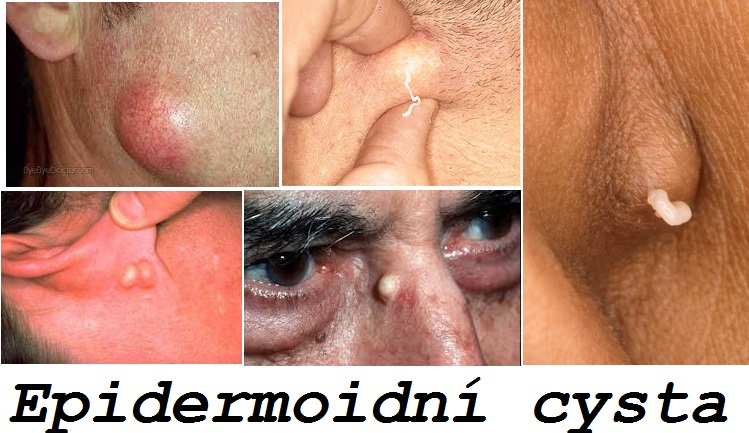 epidermoidni-cysta-priznaky-projevy-symptomy