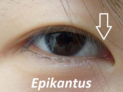 epikantus ocniho vicka priznaky projevy symptomy pricina lecba