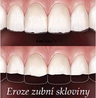 eroze zubni skloviny priznaky projevy symptomy fotografie obrazek
