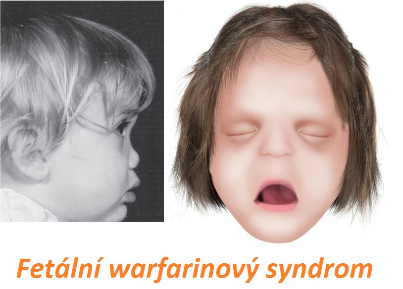 fatalni warfarinovy syndrom priznaky projevy symptomy pricina lecba