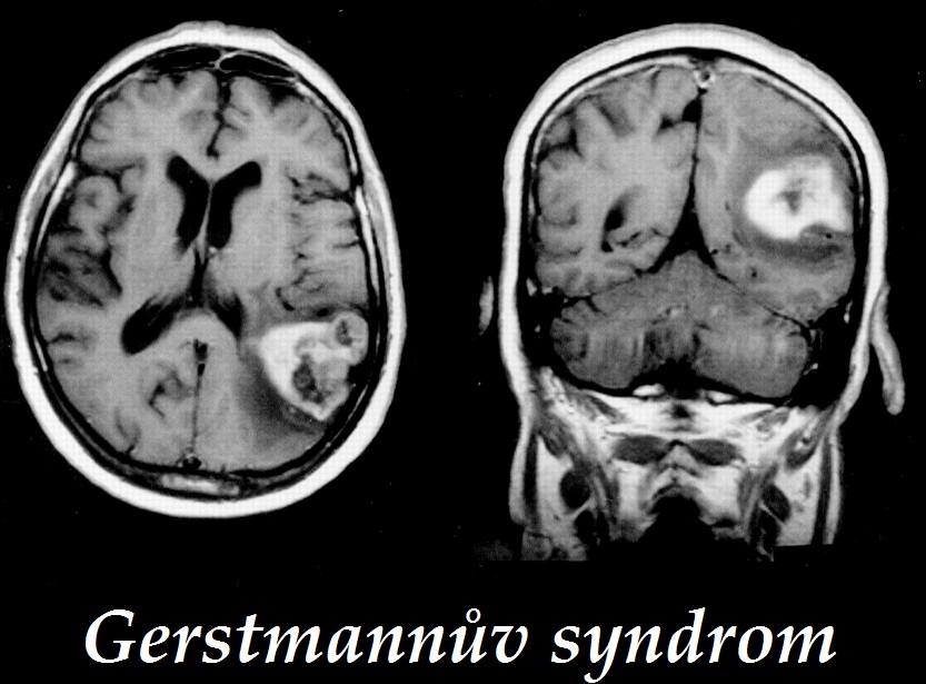 gerstmannuv-syndrom-priznaky-projevy-symptomy