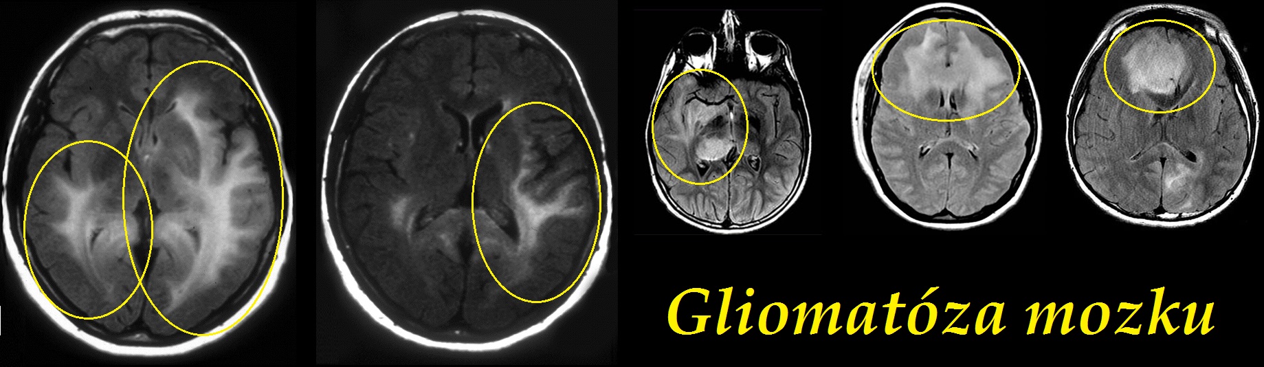 gliomatoza mozku gliomatosis cerebri priznaky projevy symptomy