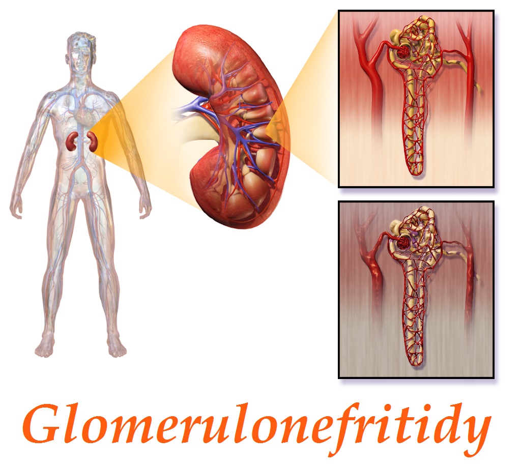 glomerulonefritida-zanet-ledviny-priznaky-projevy-symptomy