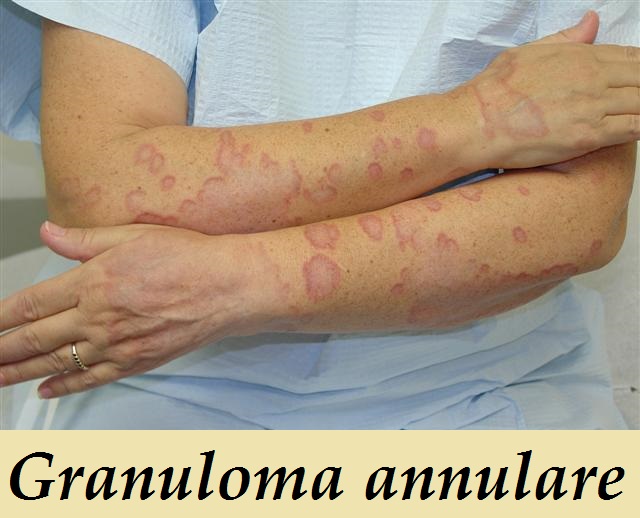 granuloma-annulare-priznaky-projevy-symptomy