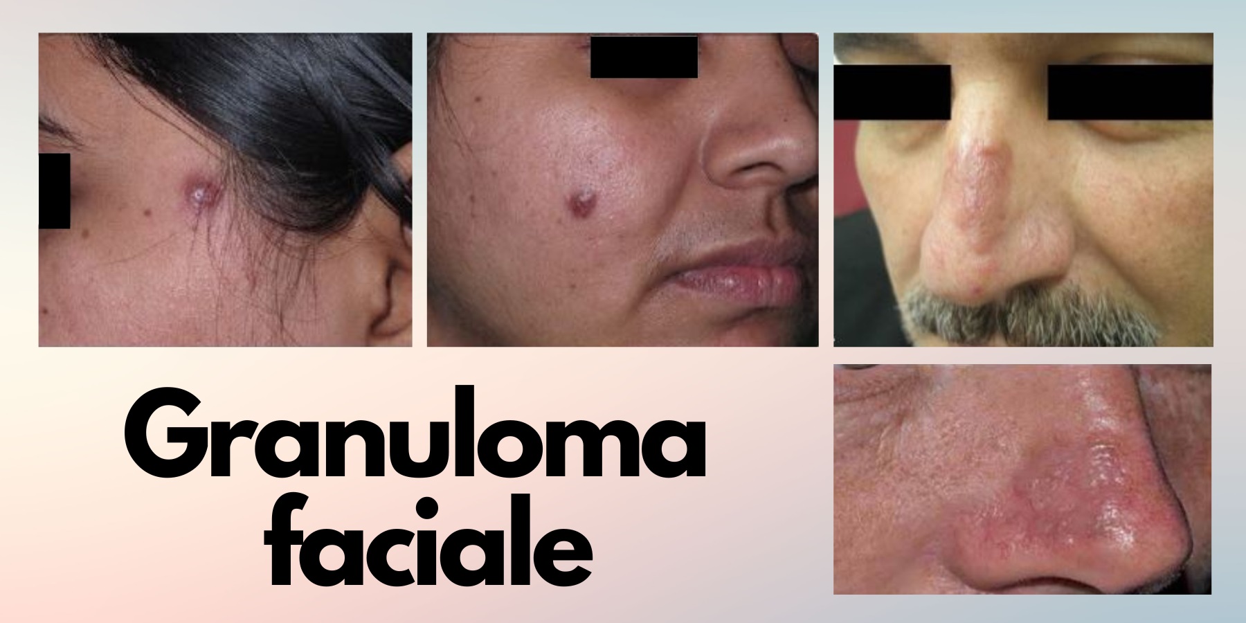 granuloma faciale priznaky projevy symptomy fotografie diagnostika lecba pricina