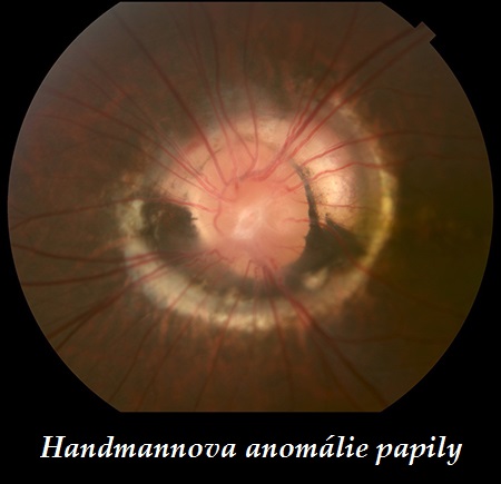 handmannova anomalie papily priznaky projevy symptomy pricina lecba fotografie obrazek