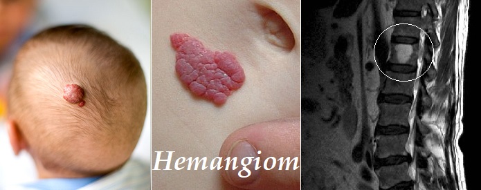 Hemangiom fotografie obrázek příznaky projevy příčina léčba