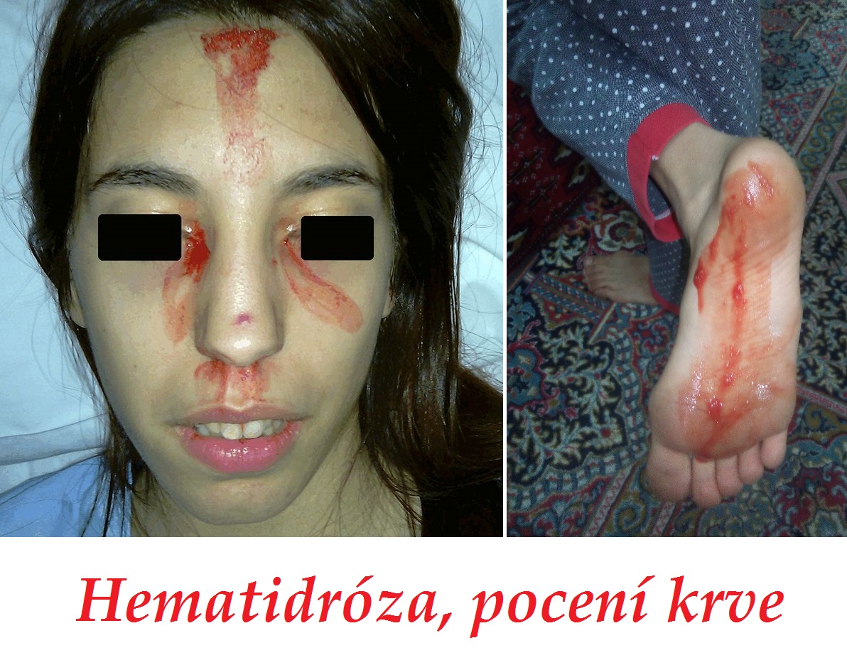 hematidroza poceni krve priznaky projevy symptomy pricina lecba fotografie obrazek