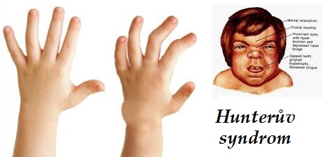 hunteruv syndrom mukopolysacharidoza ii priznaky projevy symptomy pricina lecba