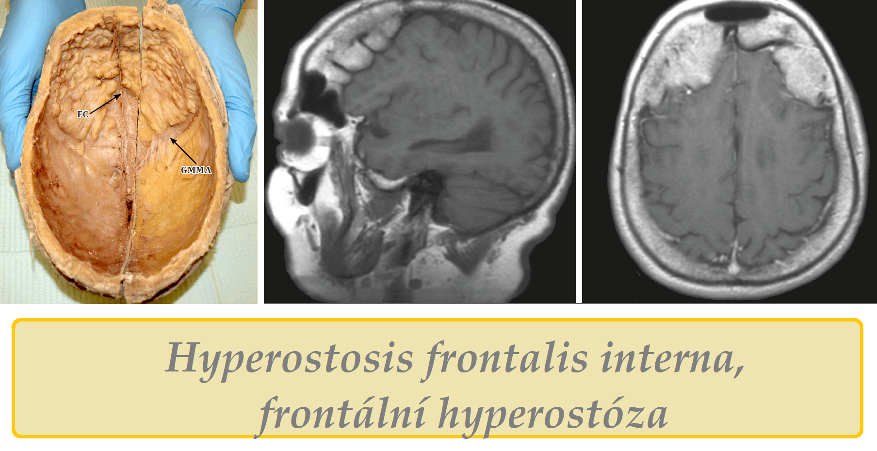 Frontální hyperostóza hyperostosis frontalis interna obrázek fotografie příznaky projevy symptomy příčina léčba