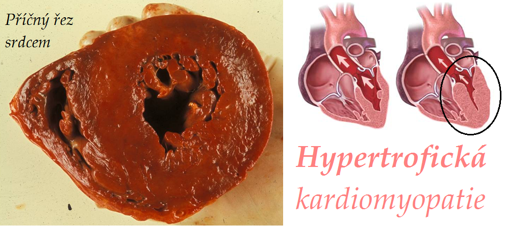 hypertroficka kardiomyopatie hkmp priznaky projevy symptomy